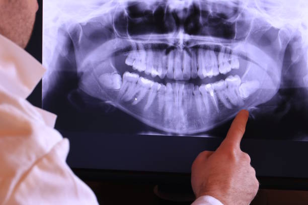 Best Knocked-Out Tooth (Avulsed Tooth) Treatment in Bayshore Gardens, FL